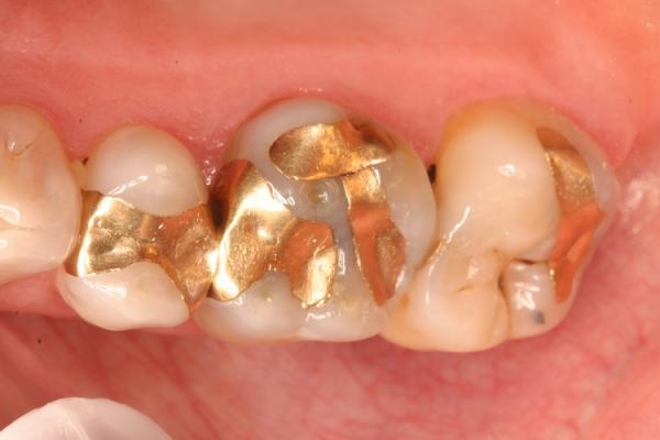 پرکردن دندان,هزینه پرکردن دندان,پرکردن دندان با طلا