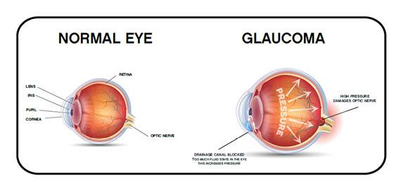 انواع بیماری آب سیاه چشم,انواع بیماری گلوکوم,گلوکوم زاویه بسته