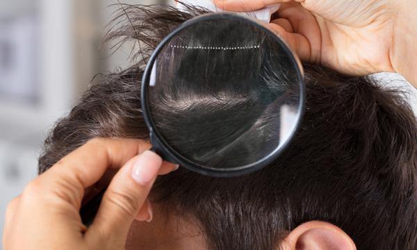 درمان ریزش مو با دارو,درمان ریزش مو,داروهای خوراکی برای درمان ریزش مو