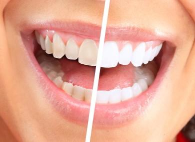 ترفندهای خانگی برای سلامت دندان,سلامت دندان,حذف لکه‌های سطحی دندان,راهکار خانگی سفید کردن دندان‌ها,کیت سفید کننده دندان