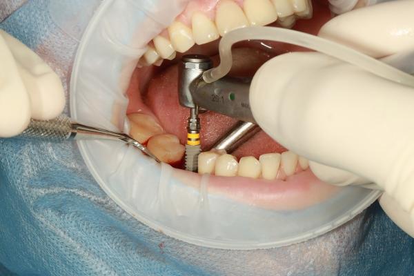 ایمپلنت دندان,انواع ایمپلنت دندان,ایمپلنت