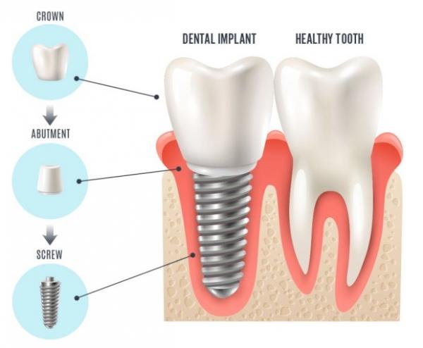 ایمپلنت,ایمپلنت دندان چیست,طول عمر ایمپلنت