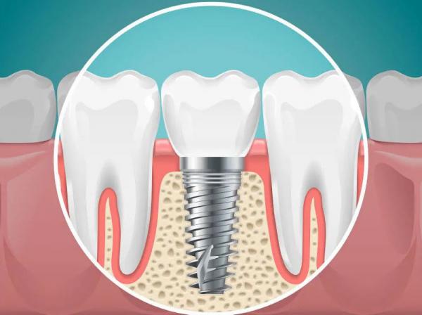 ایمپلنت,مراحل ایمپلنت دندان,جراح ایمپلنت
