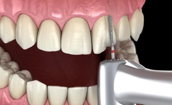 مراحل انجام لمینت دندان,لمینت دندان,لمینت سرامیکی دندان