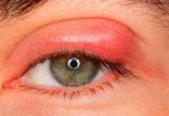 بلفاریت‌,التهاب‌ لبه‌ پلک چشم,عفونت چشم