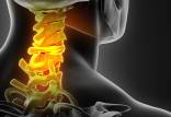 درمان دیسک گردن با ورزش,حرکات ورزشی برای درمان دیسک گردن