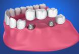 نحوه ی گذاشتن بریج دندان,بریج دندان,درمانهای زیبایی دندان