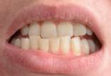 کراودینگ دندان,کراودینگ دندانی چیست,انواع کراودنیگ دندان‌ها