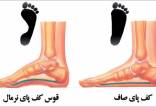 بیماری هالوکس والگوس,ضافی کف پا,درمان انحراف انگشت شست