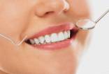 کامپوزیت دندان,کامپوزیت دندان چیست,کاربرد کاپوزیت دندانی