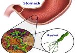 التهاب معده,بیماری زخم معده مزمن,عفونت هلیکوباکتر پیلوری