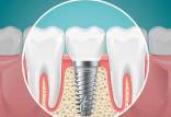 ایمپلنت,مراحل ایمپلنت دندان,جراح ایمپلنت