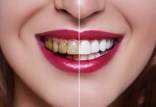 لمینت دندان,لمینت دندان معایب و مزایا,علت ترک خوردن لمینت دندان