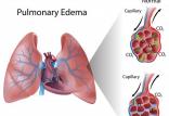 بیماری ادم ریه,علل بیماری ادم ریه, آشنایی با بیماری ادم ریه,
