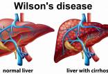 بیماری ویلسون مواد غذایی,علت بیماری ویلسون,بیماری ویلسون چیست