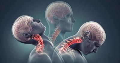 آرتروز گردن,علائم آرتروز گردن,درمان آرتروز گردن