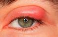 بلفاریت‌,التهاب‌ لبه‌ پلک چشم,عفونت چشم