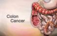 سرطان روده,نشانه های سرطان روده,درمان سرطان روده