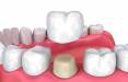 جراحی افزایش طول تاج دندان,ناحیه ی تاج دندان,ترمیم تاج دندان