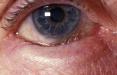 انتروپیون‌,اختلال‌ پلک‌ چشم,التهاب‌ چشم‌