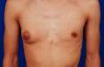 کوچک کردن پستان مردان,بهترین جراح برای کوچک کردن پستان مردان