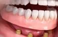 اوردنچر دندان,اوردنچر دندان چیست,انواع اوردنچر