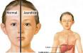 علل ، علائم و درمان سندرم ژیلبرت medical