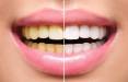 بلیچینگ دندان,بلیچینگ دندان چیست,بلیچینگ دندان در خانه