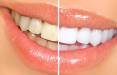 سفید کردن دندان,روش طبیعی سفید کردن دندان,سفیدکننده طبیعی دندان
