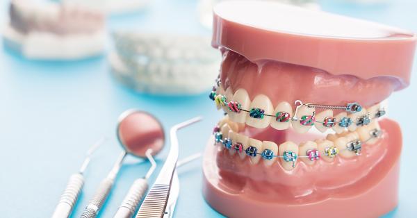ارتودنسی دندان,انواع ارتودنسی,ارتودنسی