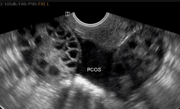 تشخیص سونوگرافی در سندرم تخمدان پلی کیستیک