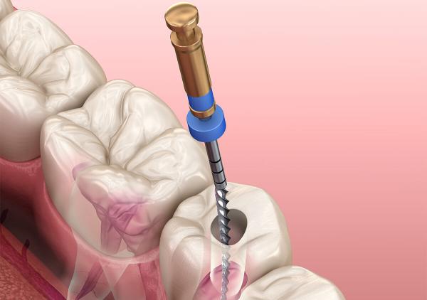ابزارهای دندانپزشکی برای عصب کشی دندان