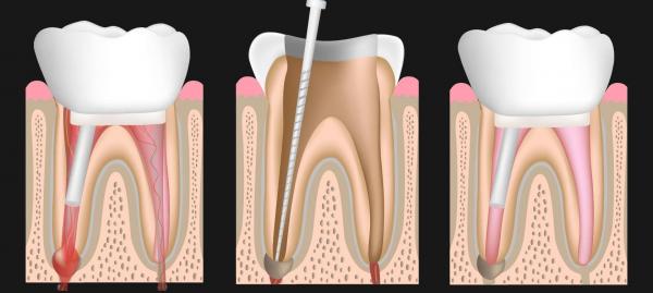مراحل مختلف عصب کشی دندان