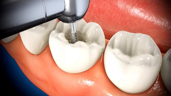 خالی کردن دندان برای انجام عصب کشی دندان