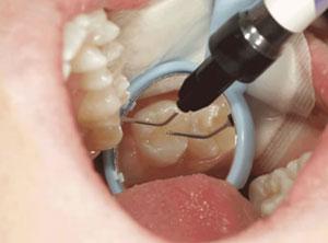 دهان و دندان,راز سلامتی دندان,علت درد دندان