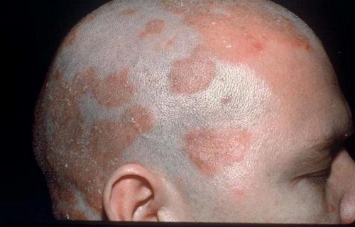 بیماری درماتیت سبورئیک,خارش پوست سر,بیماری التهاب پوستی