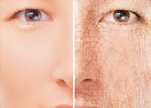ماسک صورت برای پوست خشک,پوست خشک,راه درمان خشکی پوست