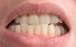 کراودینگ دندان,کراودینگ دندانی چیست,انواع کراودنیگ دندان‌ها