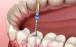درد عصب کشی دندان,مراحل عصب کشی دندان,روش های عصب کشی دندان