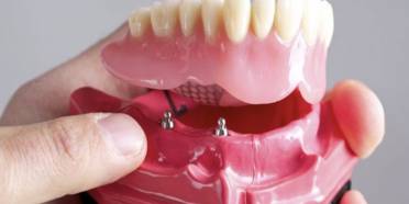 عوارض دندان مصنوعی بیشتر است یا اوردنچر؟