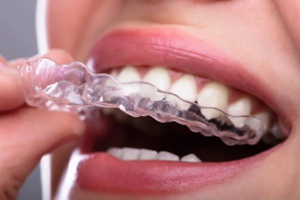 قالب شفاف برای صاف کردن دندان
