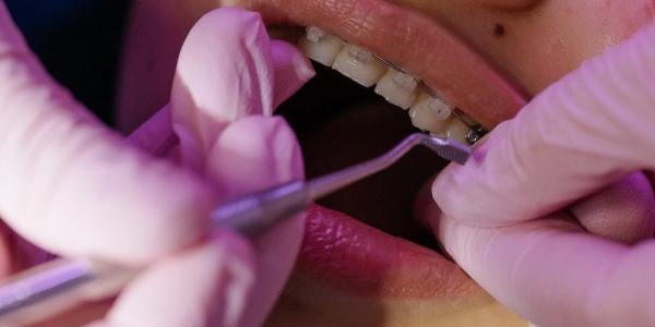 جلسات دندانپزشکی برای صاف کردن دندان