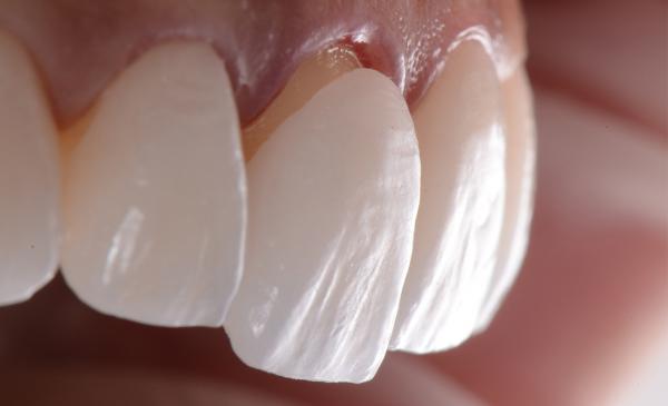 سفید کردن دندان‌ها,وایتینگ دندان,سفید کردن دندان با روش ونیر لمینت