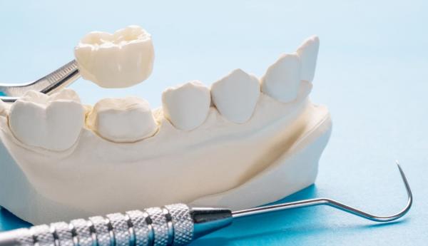 سفید کردن دندان‌ها,وایتینگ دندان,سفید کردن دندان با روش باندینگ دندان