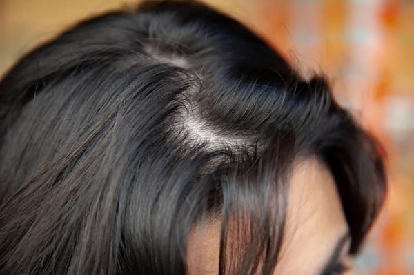 نازک شدن موی زنان