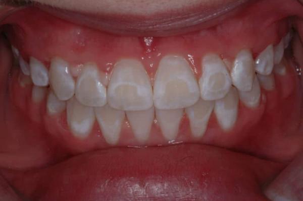 لکه گیری دندان,از بین بردن لکه های داخلی دندان