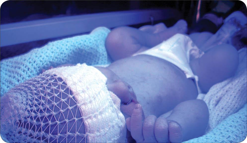 زردی نوزاد,علت زردی نوزاد,درمان زردی نوزاد