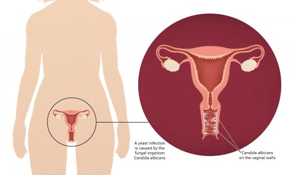 رفع خارش واژن,خارش واژن,درمان سوزش و خارش واژن