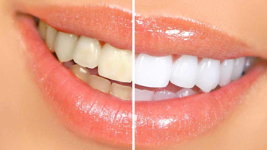 سفید کردن دندان,روش طبیعی سفید کردن دندان,سفیدکننده طبیعی دندان