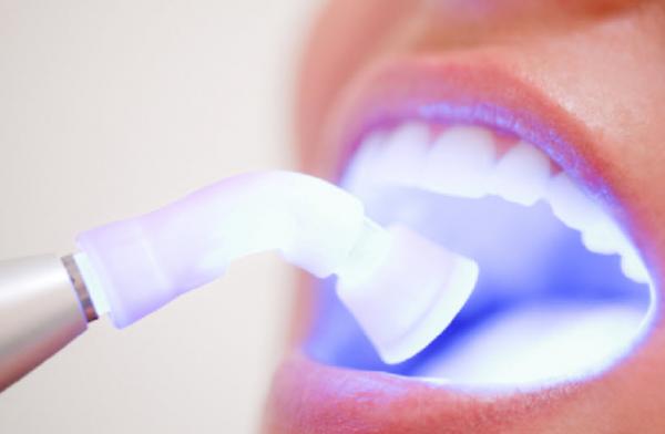 سفید کردن دندان ها,طریقه سفید کردن دندان,سفید کردن دندان